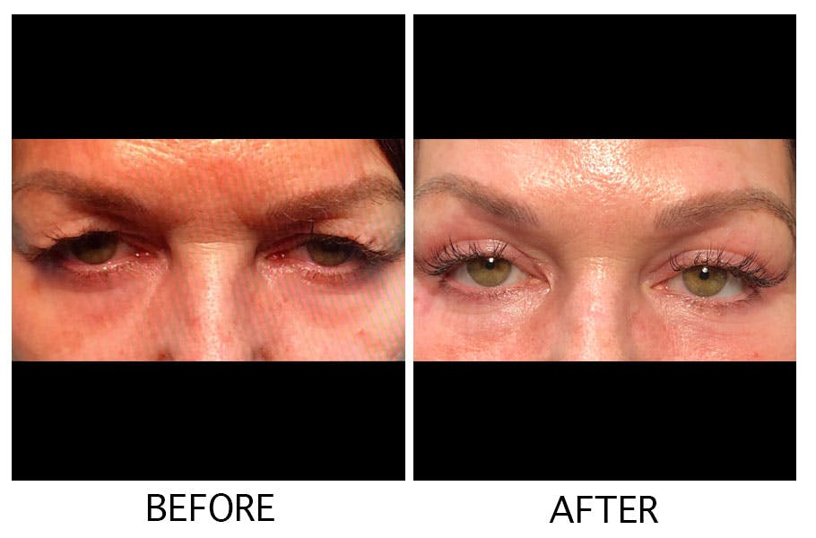 Blepharoplasty (Eyelid Surgery) Before & After Gallery - Patient 55495958 - Image 1