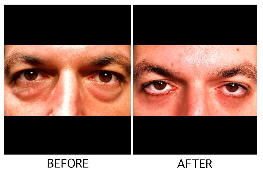 Blepharoplasty (Eyelid Surgery) Before & After Gallery - Patient 55495959 - Image 1
