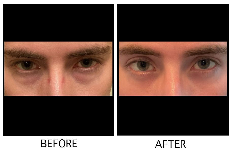 Blepharoplasty (Eyelid Surgery) Before & After Gallery - Patient 55495960 - Image 1