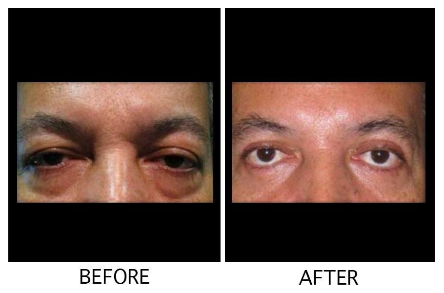 Blepharoplasty (Eyelid Surgery) Before & After Gallery - Patient 55495961 - Image 1