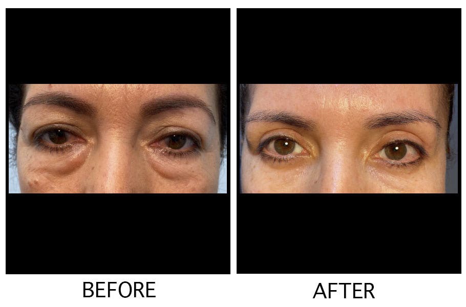Blepharoplasty (Eyelid Surgery) Before & After Gallery - Patient 55495962 - Image 1
