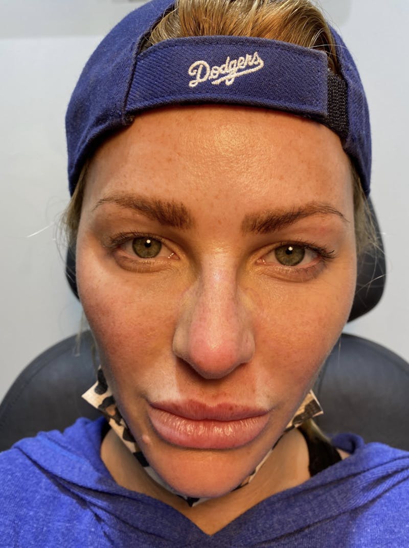 Blepharoplasty (Eyelid Surgery) Before & After Gallery - Patient 63988924 - Image 1