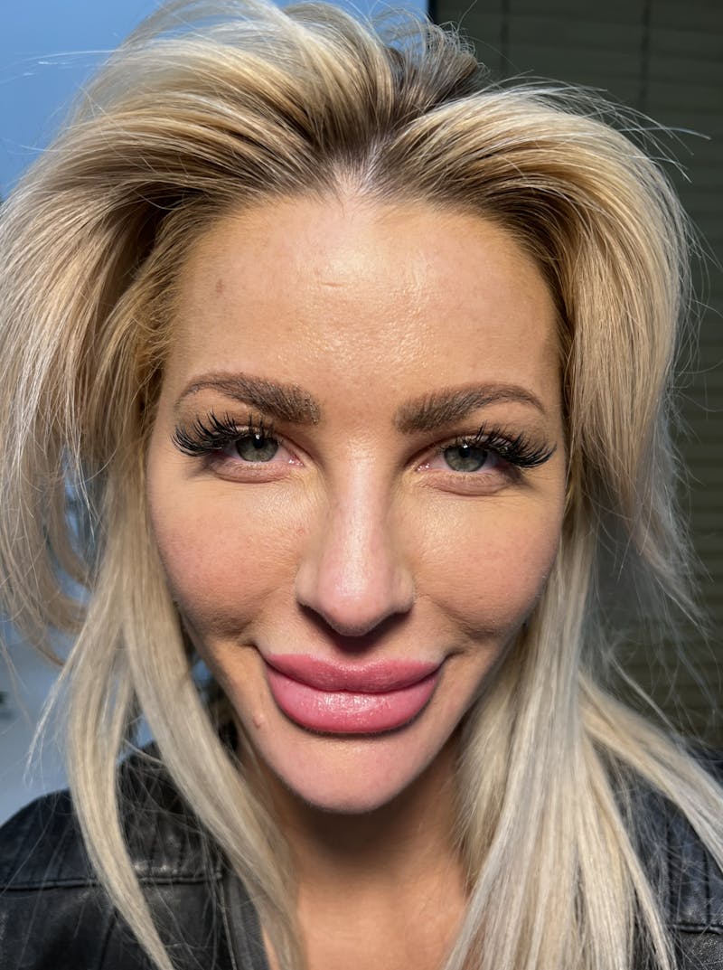 Blepharoplasty (Eyelid Surgery) Before & After Gallery - Patient 63988924 - Image 2