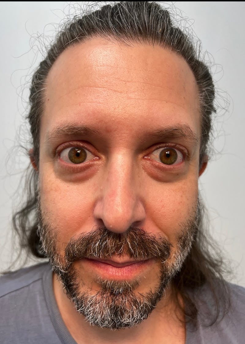 Blepharoplasty (Eyelid Surgery) Before & After Gallery - Patient 64032084 - Image 1