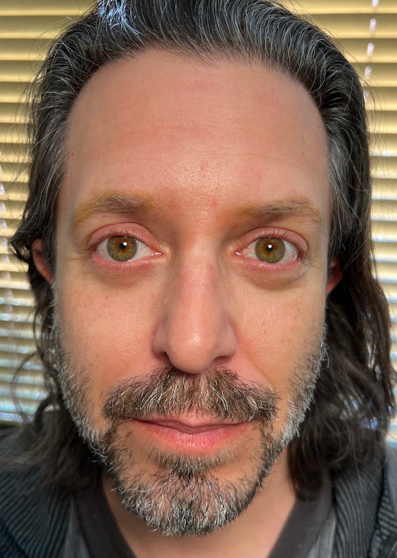 Blepharoplasty (Eyelid Surgery) Before & After Gallery - Patient 64032084 - Image 2