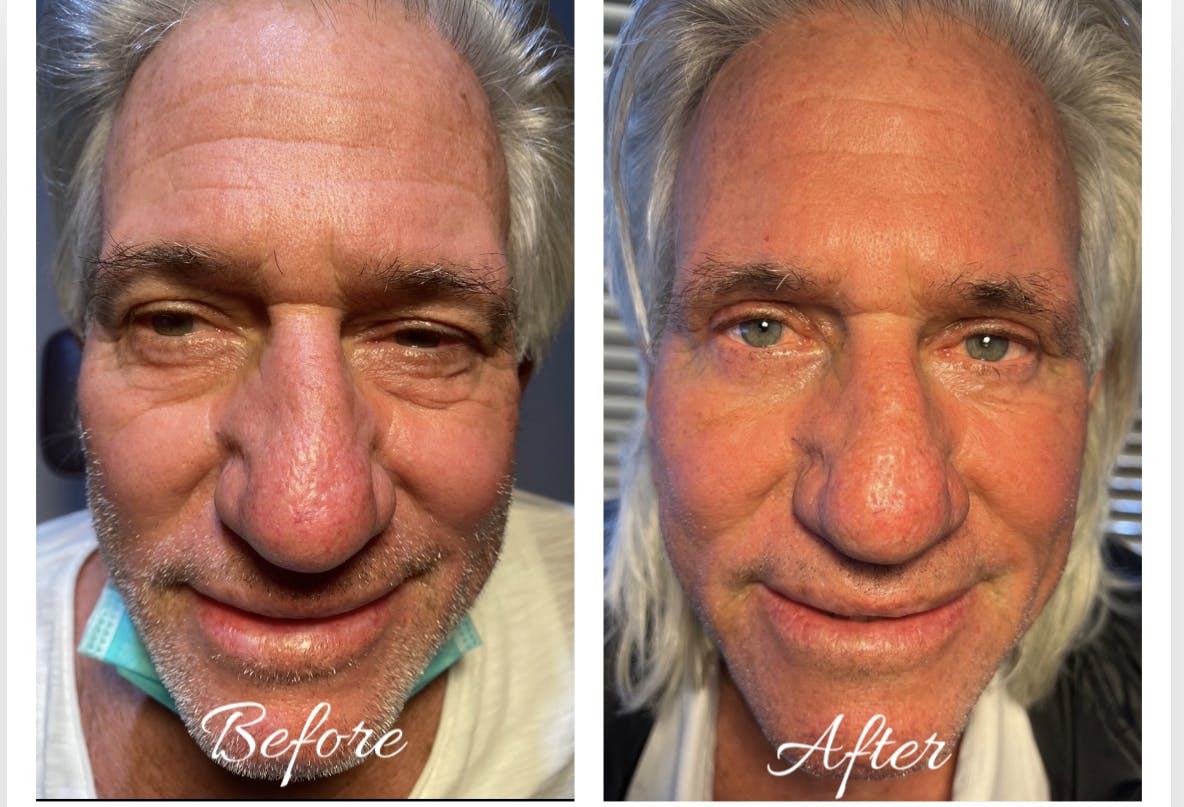 Blepharoplasty (Eyelid Surgery) Before & After Gallery - Patient 106375164 - Image 1