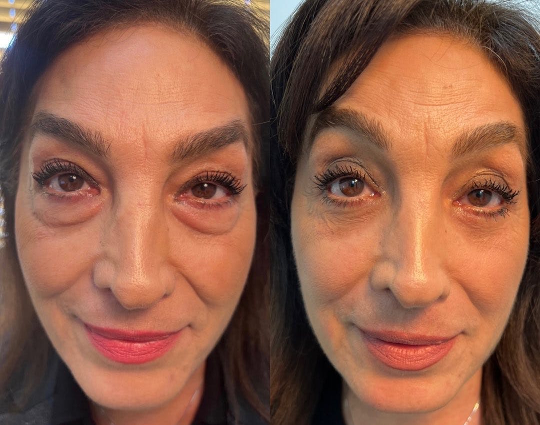 Blepharoplasty (Eyelid Surgery) Before & After Gallery - Patient 106375755 - Image 1