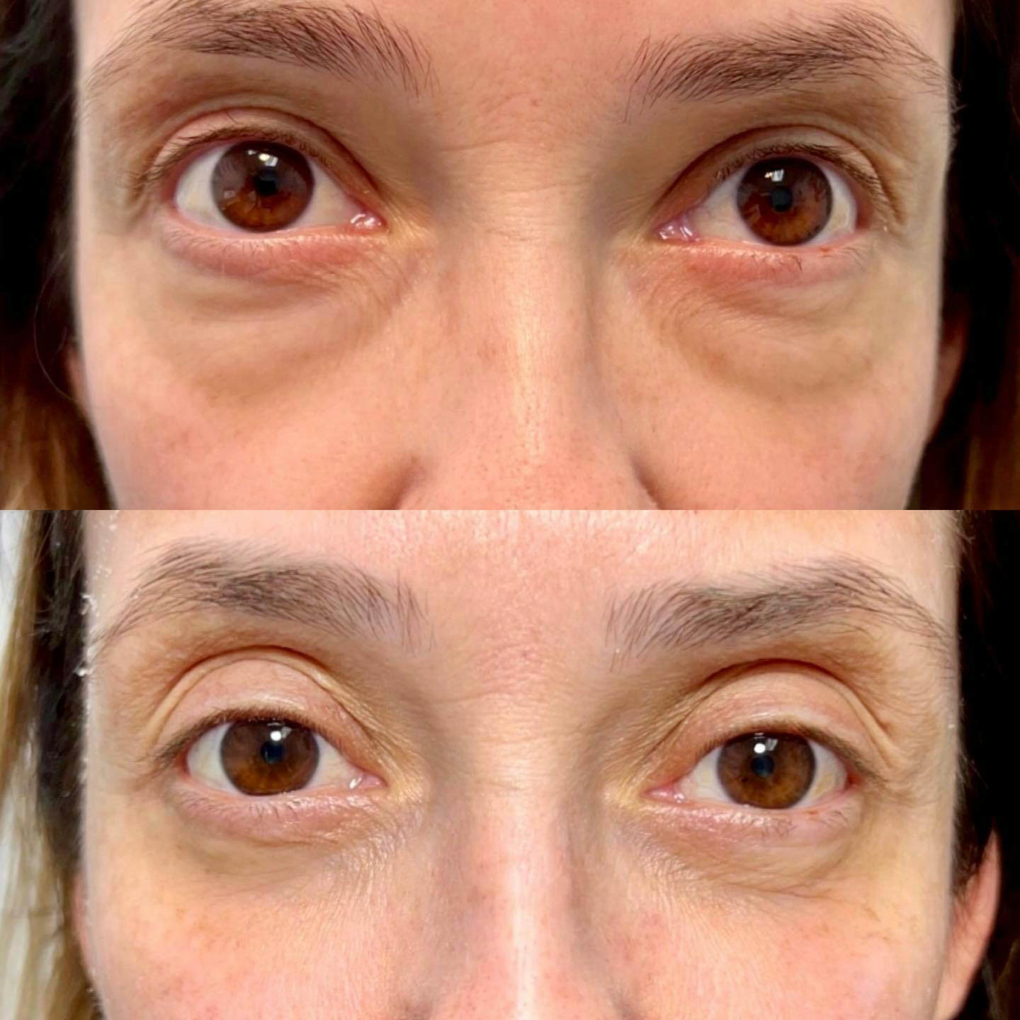 Blepharoplasty (Eyelid Surgery) Before & After Gallery - Patient 106375789 - Image 1