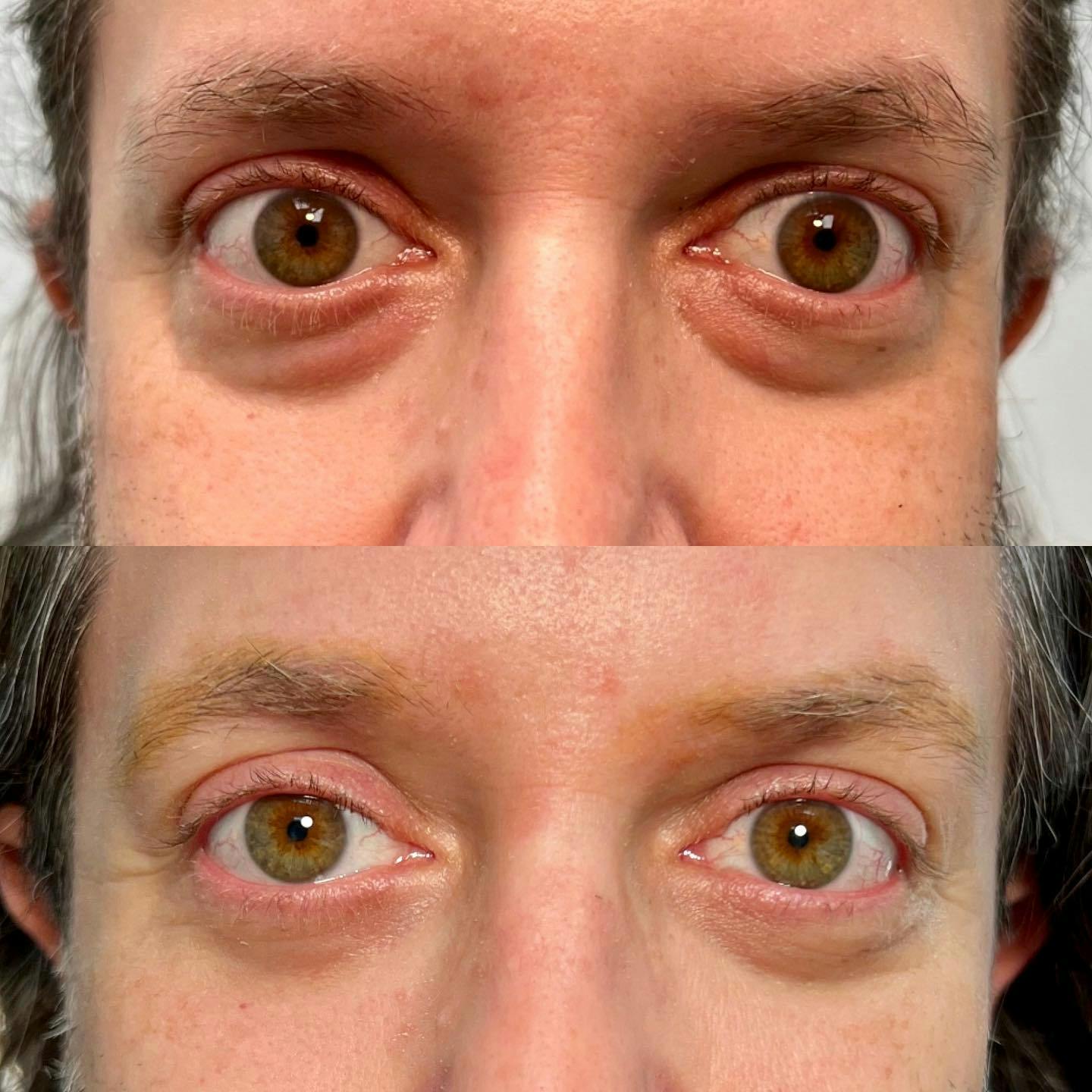 Blepharoplasty (Eyelid Surgery) Before & After Gallery - Patient 106375798 - Image 1