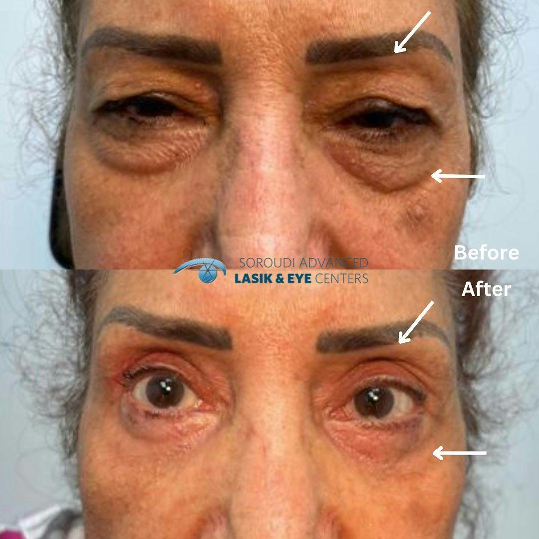 Blepharoplasty (Eyelid Surgery) Before & After Gallery - Patient 133768469 - Image 1