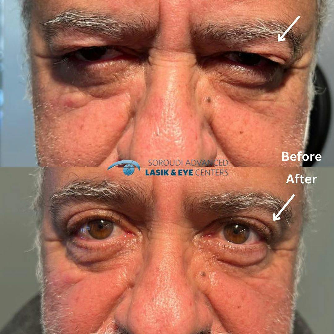 Blepharoplasty (Eyelid Surgery) Before & After Gallery - Patient 133768470 - Image 1