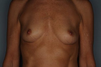 Breast Augmentation Before & After Gallery - Patient 55475001 - Image 1