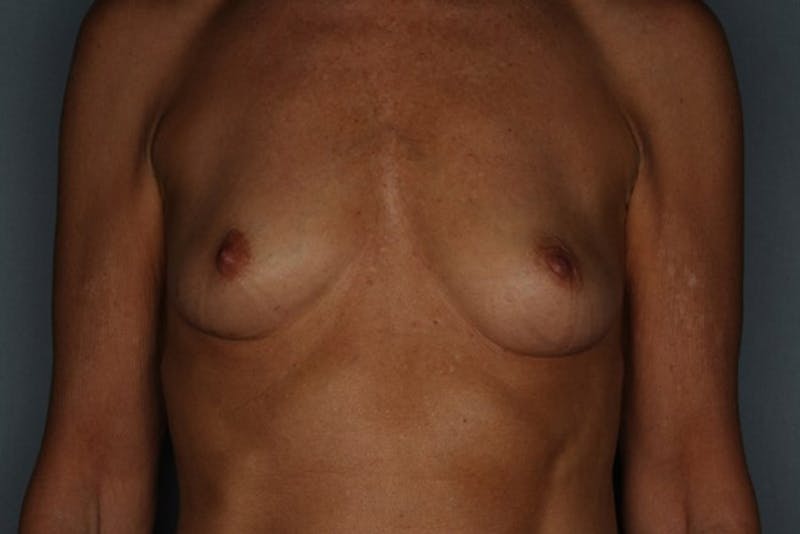 Breast Augmentation Before & After Gallery - Patient 55475001 - Image 1