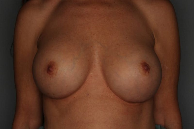 Breast Augmentation Before & After Gallery - Patient 55475001 - Image 2