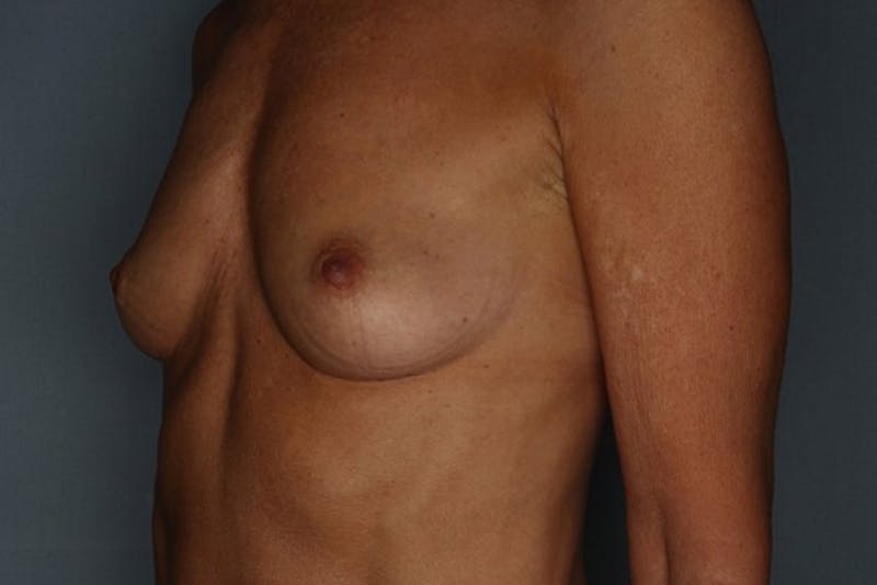 Breast Augmentation Before & After Gallery - Patient 55475001 - Image 3