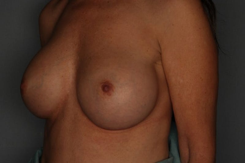 Breast Augmentation Before & After Gallery - Patient 55475001 - Image 4