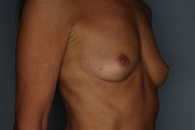 Breast Augmentation Before & After Gallery - Patient 55475001 - Image 5