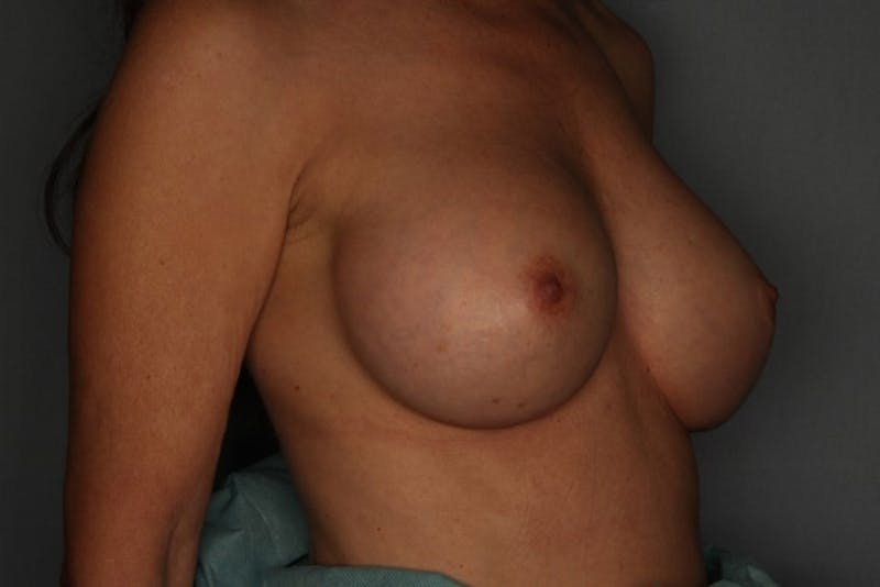 Breast Augmentation Before & After Gallery - Patient 55475001 - Image 6