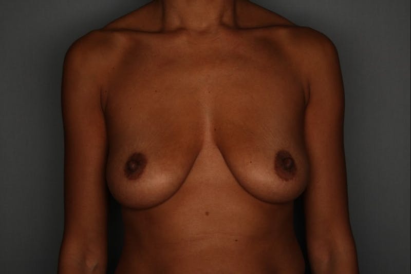 Breast Augmentation Before & After Gallery - Patient 55475002 - Image 1