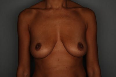 Breast Augmentation Before & After Gallery - Patient 55475002 - Image 1