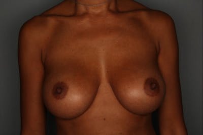 Breast Augmentation Before & After Gallery - Patient 55475002 - Image 2