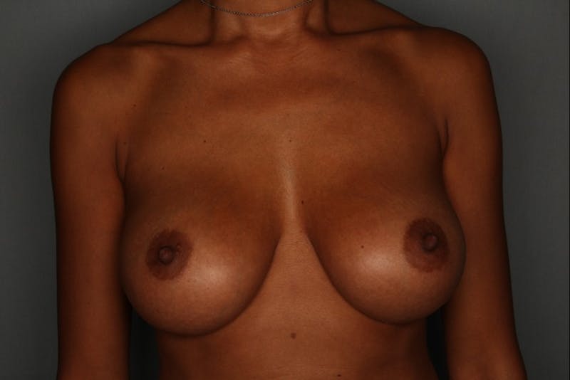 Breast Augmentation Before & After Gallery - Patient 55475002 - Image 2