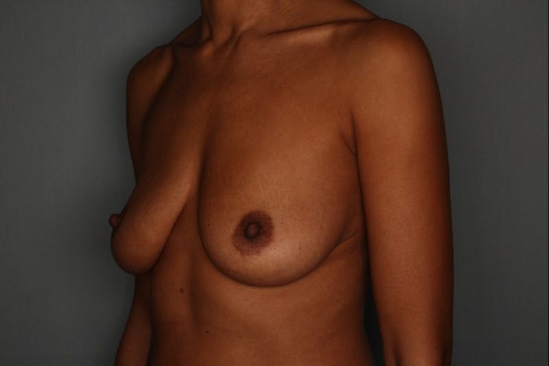Breast Augmentation Before & After Gallery - Patient 55475002 - Image 3