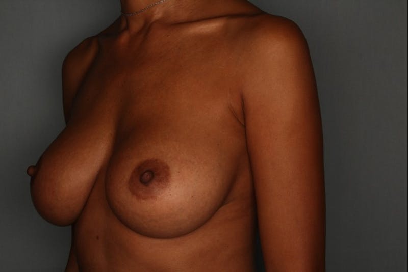 Breast Augmentation Before & After Gallery - Patient 55475002 - Image 4