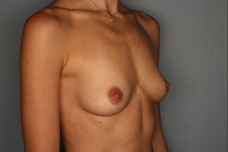 Breast Augmentation Before & After Gallery - Patient 55475003 - Image 1