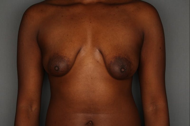 Breast Augmentation Before & After Gallery - Patient 55475005 - Image 1