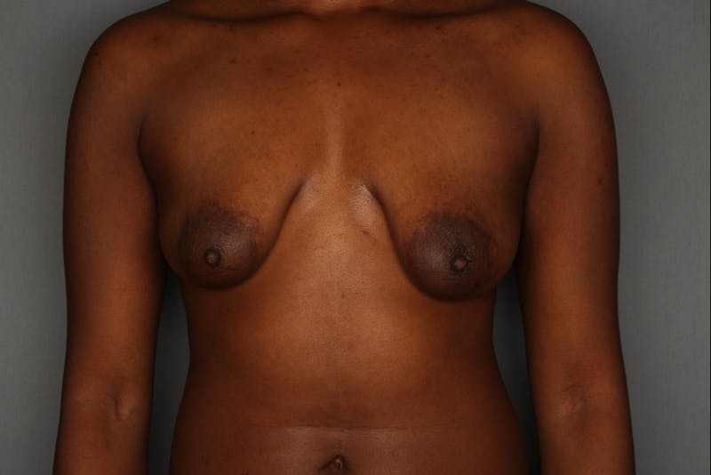Breast Augmentation Before & After Gallery - Patient 55475005 - Image 1