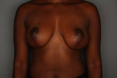 Breast Augmentation Before & After Gallery - Patient 55475005 - Image 2