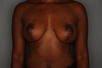 Breast Augmentation Before & After Gallery - Patient 55475005 - Image 2