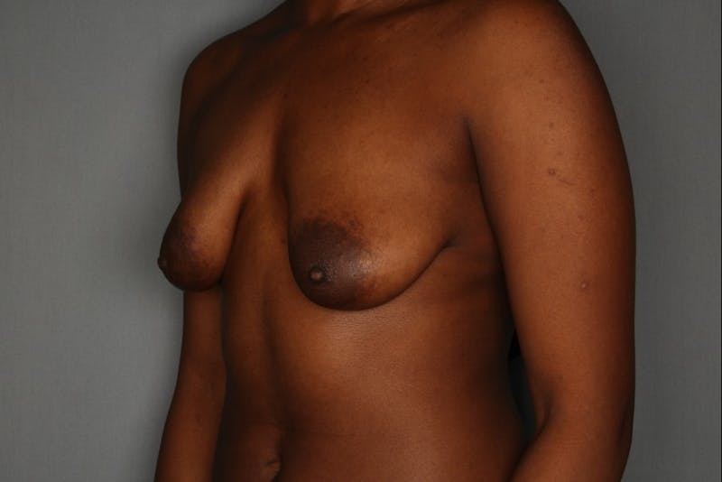 Breast Augmentation Before & After Gallery - Patient 55475005 - Image 3