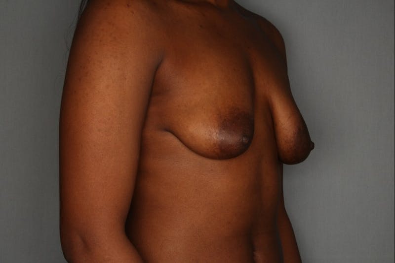 Breast Augmentation Before & After Gallery - Patient 55475005 - Image 5