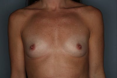 Breast Augmentation Before & After Gallery - Patient 55475006 - Image 1