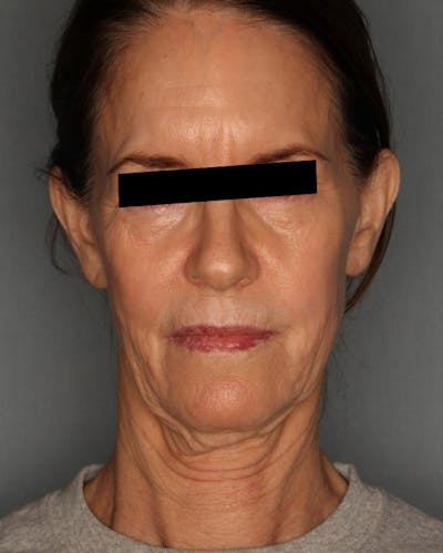 Facelift Before & After Gallery - Patient 55475007 - Image 1