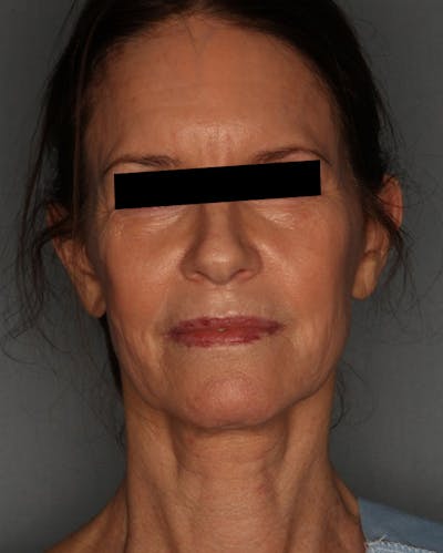 Facelift Before & After Gallery - Patient 55475007 - Image 2