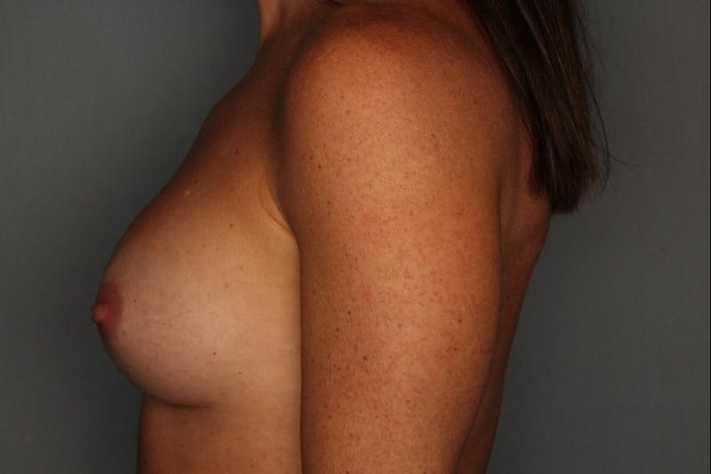 Breast Augmentation Before & After Gallery - Patient 55475006 - Image 6
