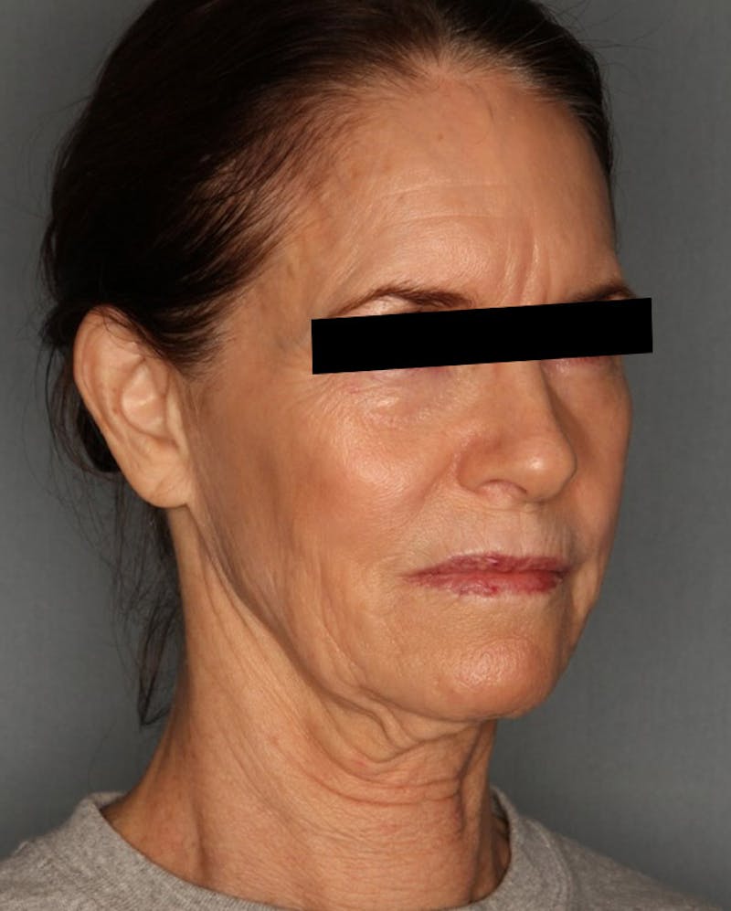 Facelift Before & After Gallery - Patient 55475007 - Image 3