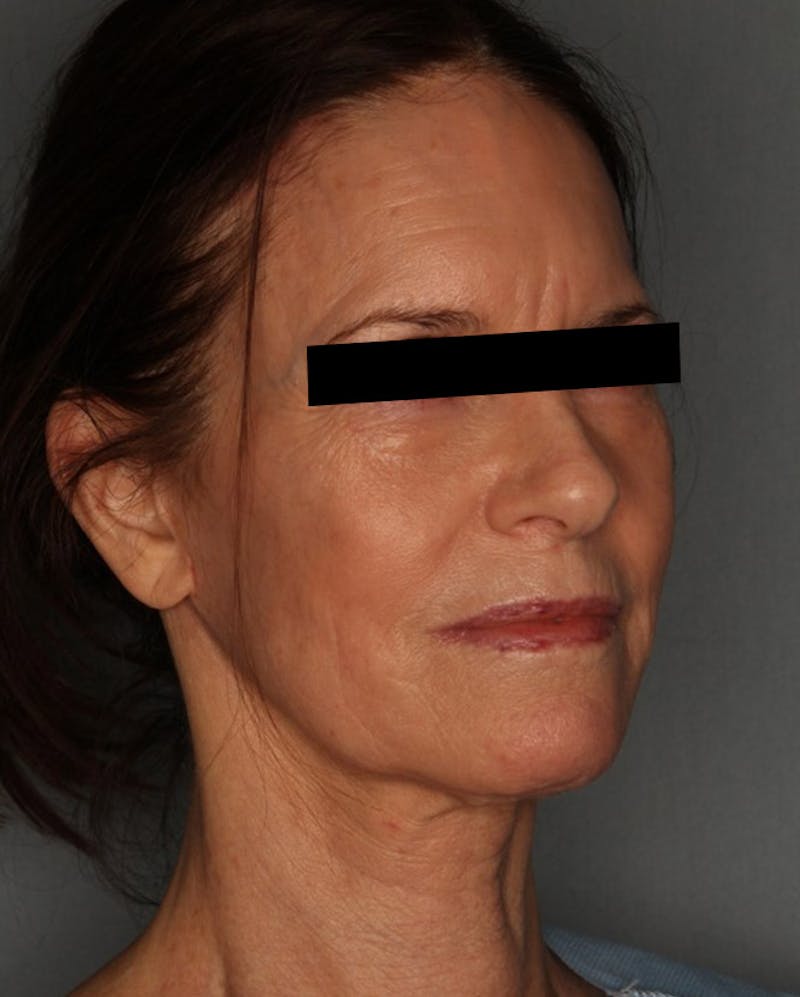 Facelift Before & After Gallery - Patient 55475007 - Image 4