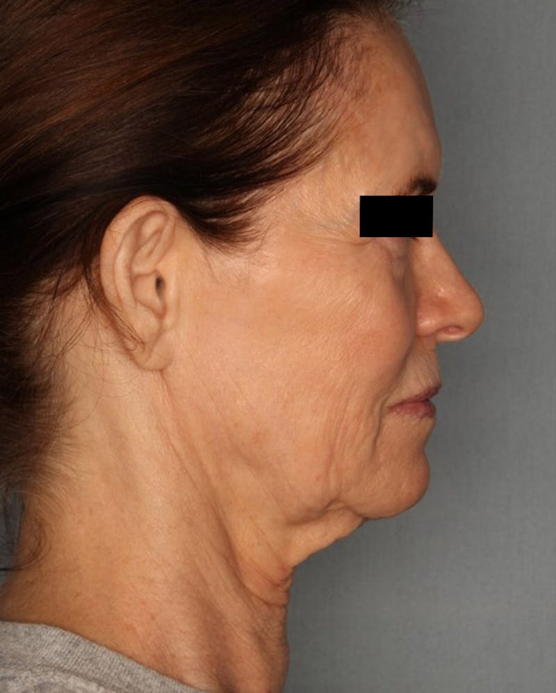 Facelift Before & After Gallery - Patient 55475007 - Image 5