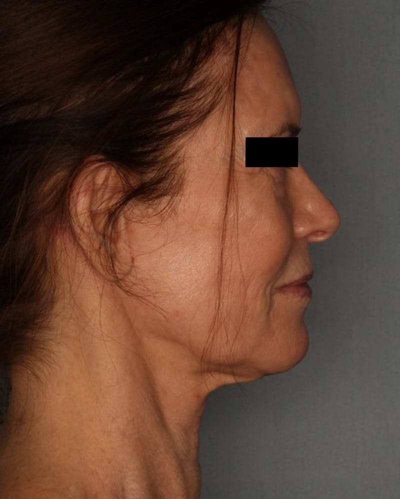 Facelift Before & After Gallery - Patient 55475007 - Image 6