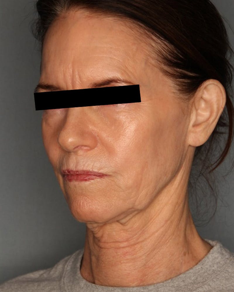 Facelift Before & After Gallery - Patient 55475007 - Image 7