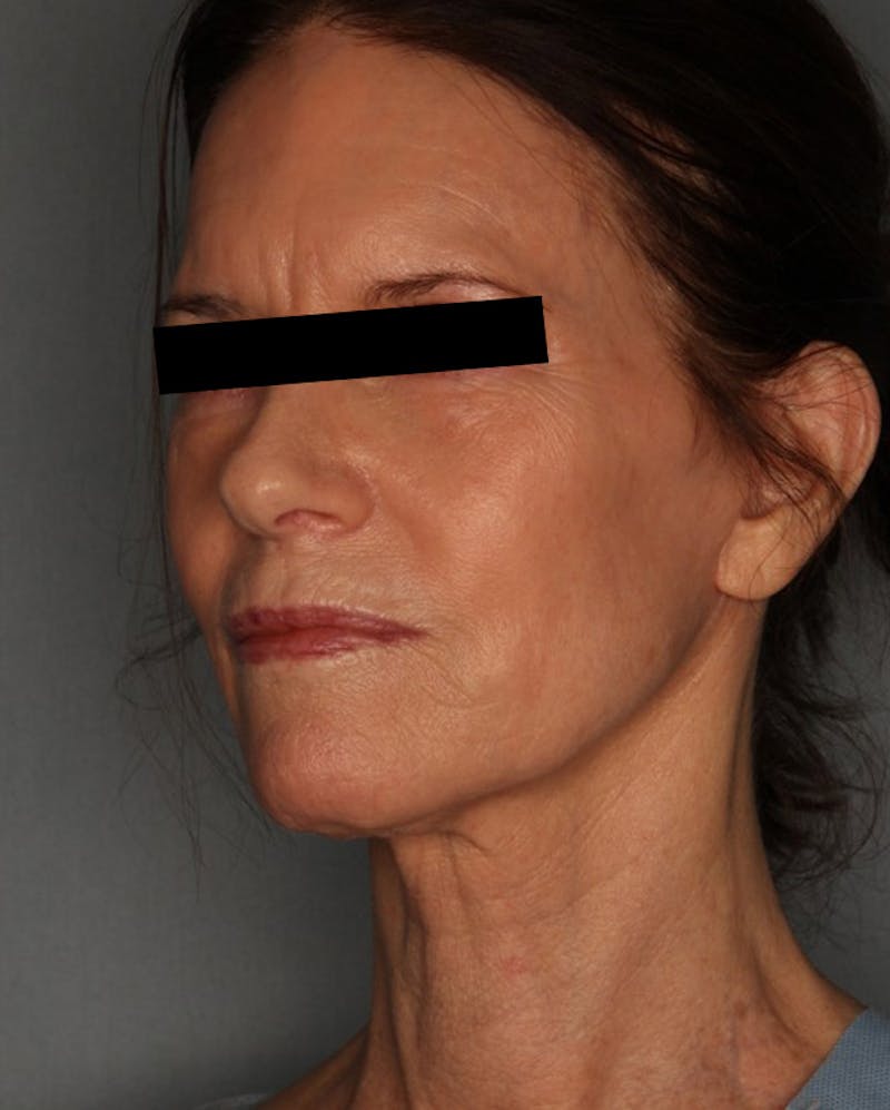 Facelift Before & After Gallery - Patient 55475007 - Image 8