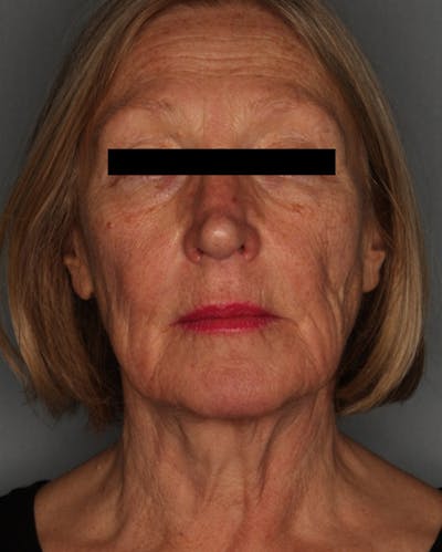 Facelift Before & After Gallery - Patient 55475009 - Image 1