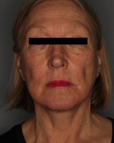 Facelift Before & After Gallery - Patient 55475009 - Image 2