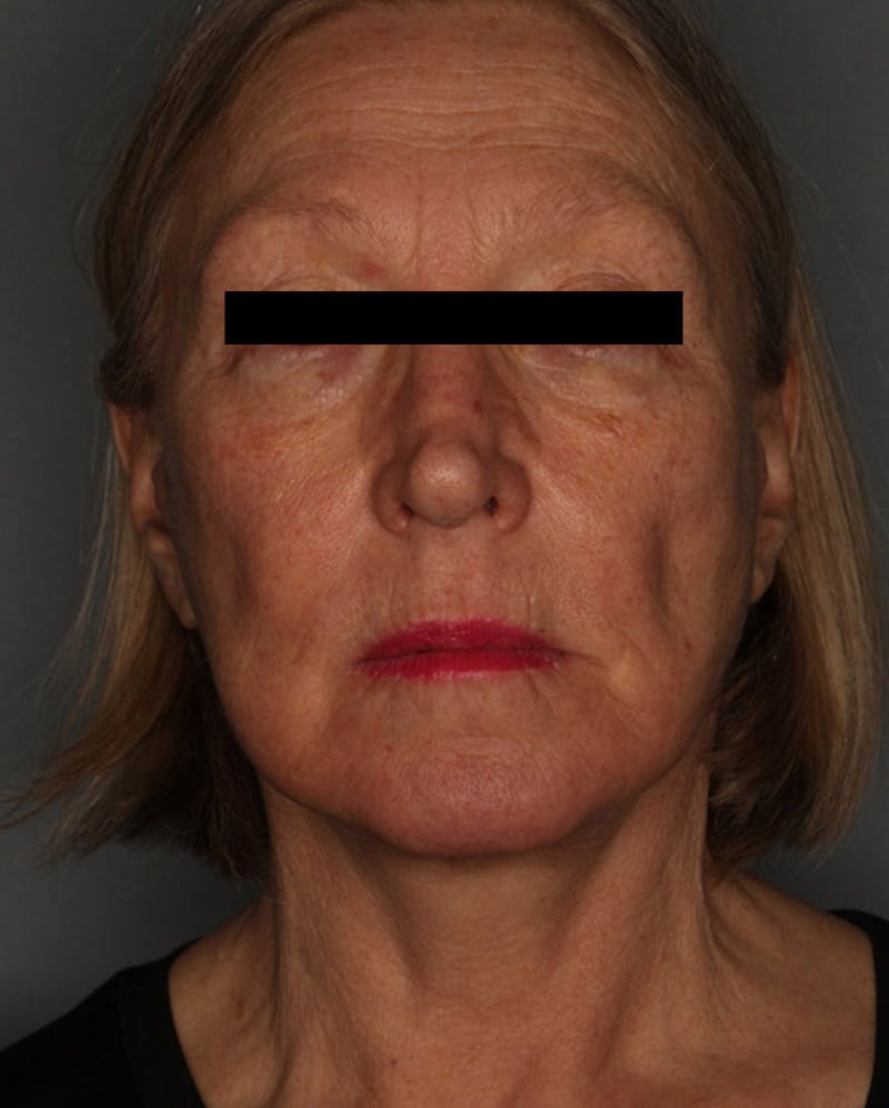 Facelift Before & After Gallery - Patient 55475009 - Image 2