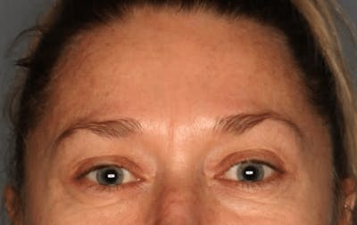 Blepharoplasty Before & After Gallery - Patient 55475010 - Image 1