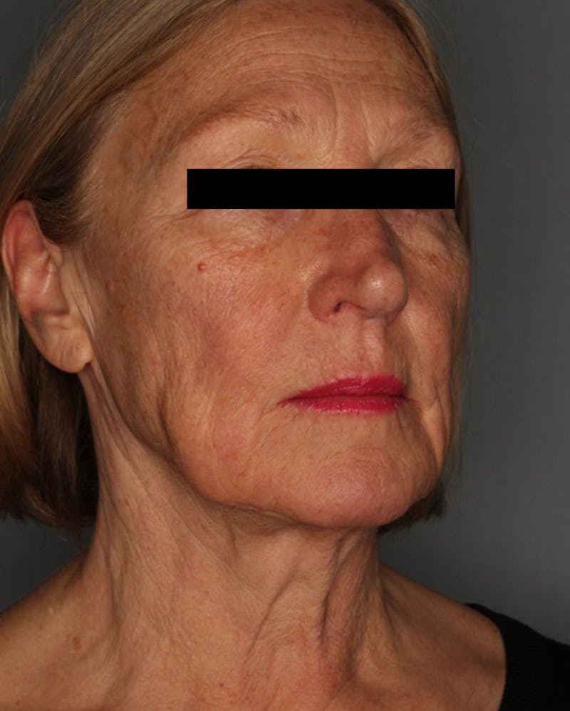 Facelift Before & After Gallery - Patient 55475009 - Image 3